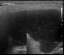 Image result for Parotid Cyst Ultrasound