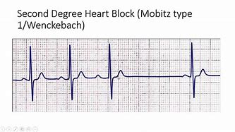 Image result for Mobitz Type 3 EKG