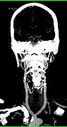 Image result for Carotid Artery X-ray
