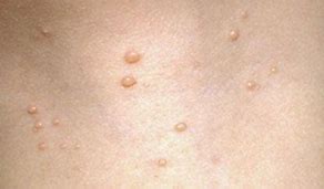 Image result for Moscullum Contagiosum