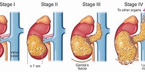 Image result for How Big Is 12 Cm Tumor