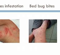 Image result for scabies bed bug signs