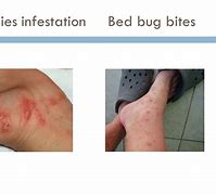 Image result for Scabies Bed Bugs