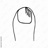 Image result for Onychomycosis