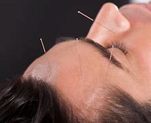 Image result for Migraine Acupuncture