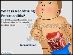 Image result for enterocolitis