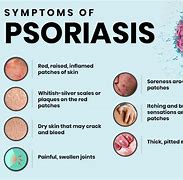 Image result for Psoriasis Biologics