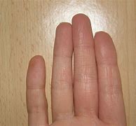Image result for Swollen Knuckle On Middle Finger