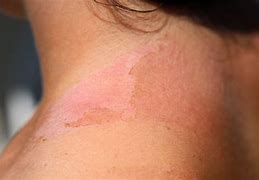 Image result for SunBurn Skin Cancer