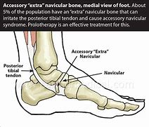 Image result for Accessory Navicular Bone Syndrome