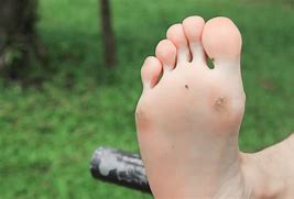 Image result for Molluscum Contagiosum Bottom of Foot