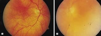 Image result for Mycosis Fungoides Eye