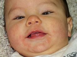 Image result for Apple Allergy Baby