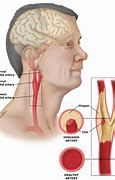 Image result for What Is Carotid Upstroke