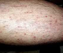 Image result for Fungal Rash On Lower Leg
