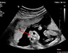 Image result for Acrania On OB Ultrasound