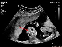 Image result for Anencephaly Ultrasound 3rd Trimester