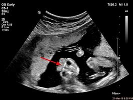 Image result for Anencephaly Ultrasound Images