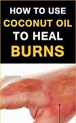 Image result for Sun Burn Coconut Oil
