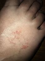 Image result for Red Itchy Spots On Foot
