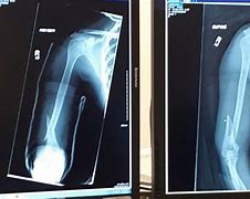 Image result for Broken Arm Injury