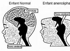 Image result for Anencephaly Disease