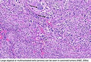 Image result for Carcinoid Tumor Gross