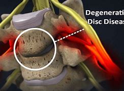 Image result for Degenerative Disc Disease Thoracic Spine