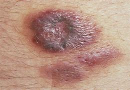 Image result for Types of Kaposi Sarcoma