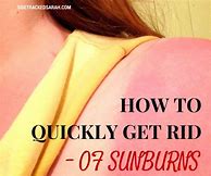Image result for bad sunburn remedies