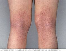 Image result for Eczema Skin Rashes in Adults