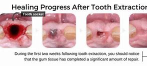Image result for Tooth Extraction Recovery
