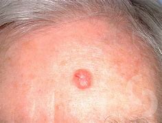 Image result for Cystic Basal Cell Carcinoma
