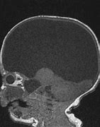 Image result for Hydranencephaly Brain Image