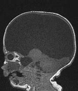 Image result for Hydranencephaly Brain Images