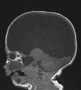 Image result for Hydranencephaly Radiology