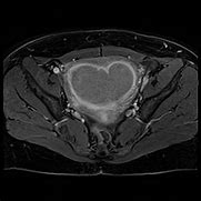 Image result for Uterine Fibroid Degeneration