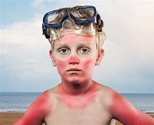 Image result for Sun Burn Dead Skin