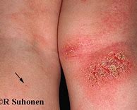 Image result for Molluscum Contagiosum vs Chicken Pox