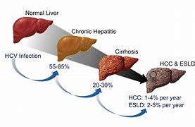 Image result for Acute Hep C