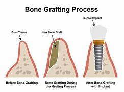 Image result for Jaw Bone After Tooth Extraction