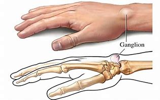 Image result for Ganglion Cyst