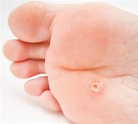 Image result for Wart Hole Foot