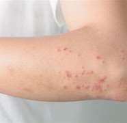 Image result for Multiple Myeloma Skin Rash