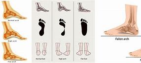 Image result for Collapsed Foot Arch Pain