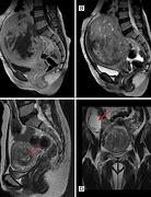 Image result for 3.5 Cm Fibroid Tumor