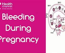 Image result for Early Pregnancy Bleeding