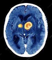 Image result for Brain Cancer CT Scan