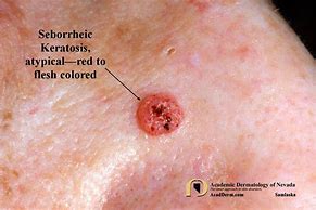 Image result for Benign Skin Lesions Keratosis