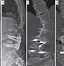 Image result for Lumbar Spinal Fusion L4-L5